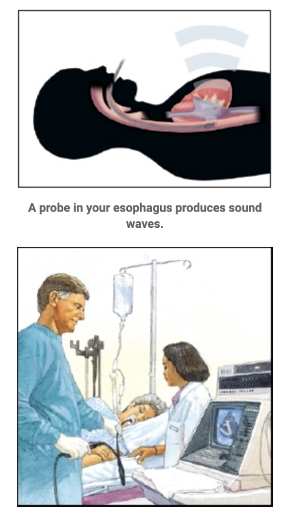 About Your Transesophageal Echocardiogram (TEE)